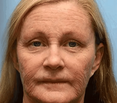 uk ð¶ððððððð ðºððððð©ââïžð| Regain youthful skin nown ð«STDEI® BOTOX & VITA A RETINOL SHOT Wrinkle Lift Tightening Cream