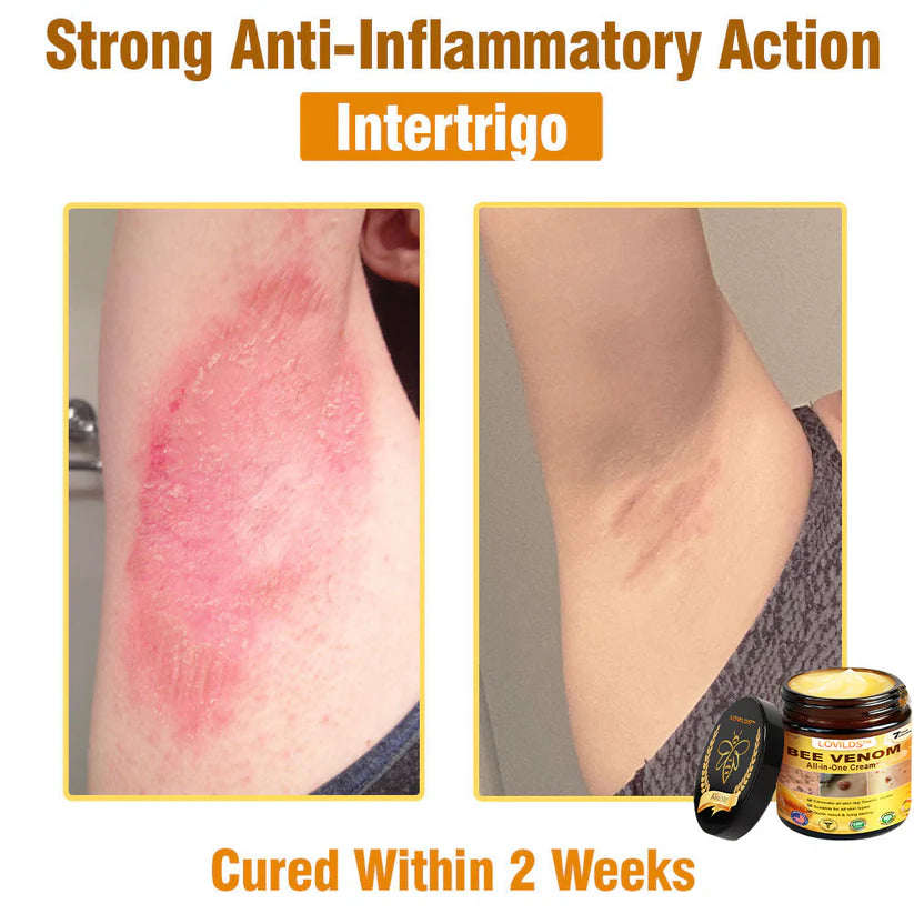 70% OFF🔥𝐋𝐎𝐕𝐈𝐋𝐃𝐒™ 𝐁𝐞𝐞 𝐕𝐞𝐧𝐨𝐦 𝐀𝐥𝐥-𝐢𝐧-𝐎𝐧𝐞 𝐂𝐫𝐞𝐚𝐦–🌸 Anti-aging,Hydrating, Skin Repair, Even Tone, Acne and Dark Spot Treatment, Wart and Mole Removal, Psoriasis Relief