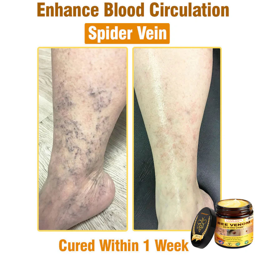 70% OFF🔥𝐋𝐎𝐕𝐈𝐋𝐃𝐒™ 𝐁𝐞𝐞 𝐕𝐞𝐧𝐨𝐦 𝐀𝐥𝐥-𝐢𝐧-𝐎𝐧𝐞 𝐂𝐫𝐞𝐚𝐦–🌸 Anti-aging,Hydrating, Skin Repair, Even Tone, Acne and Dark Spot Treatment, Wart and Mole Removal, Psoriasis Relief