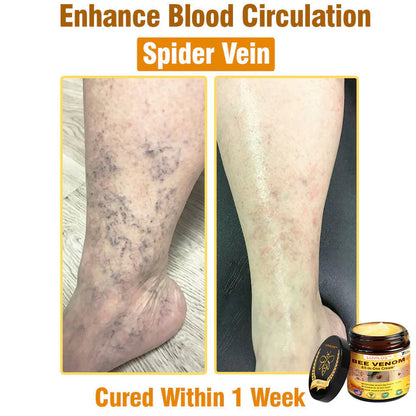 70% OFF🔥𝐋𝐎𝐕𝐈𝐋𝐃𝐒™ 𝐁𝐞𝐞 𝐕𝐞𝐧𝐨𝐦 𝐀𝐥𝐥-𝐢𝐧-𝐎𝐧𝐞 𝐂𝐫𝐞𝐚𝐦–🌸 Anti-aging,Hydrating, Skin Repair, Even Tone, Acne and Dark Spot Treatment, Wart and Mole Removal, Psoriasis Relief