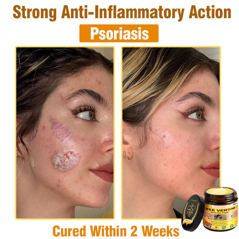 70% OFF🔥𝐋𝐎𝐕𝐈𝐋𝐃𝐒™ 𝐁𝐞𝐞 𝐕𝐞𝐧𝐨𝐦 𝐀𝐥𝐥-𝐢𝐧-𝐎𝐧𝐞 𝐂𝐫𝐞𝐚𝐦–🌸 Anti-aging,Hydrating, Skin Repair, Even Tone, Acne and Dark Spot Treatment, Wart and Mole Removal, Psoriasis Relief