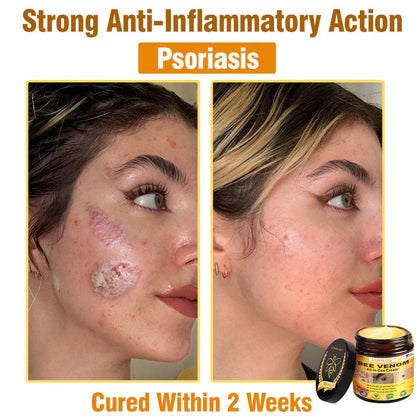 70% OFF🔥𝐋𝐎𝐕𝐈𝐋𝐃𝐒™ 𝐁𝐞𝐞 𝐕𝐞𝐧𝐨𝐦 𝐀𝐥𝐥-𝐢𝐧-𝐎𝐧𝐞 𝐂𝐫𝐞𝐚𝐦–🌸 Anti-aging,Hydrating, Skin Repair, Even Tone, Acne and Dark Spot Treatment, Wart and Mole Removal, Psoriasis Relief