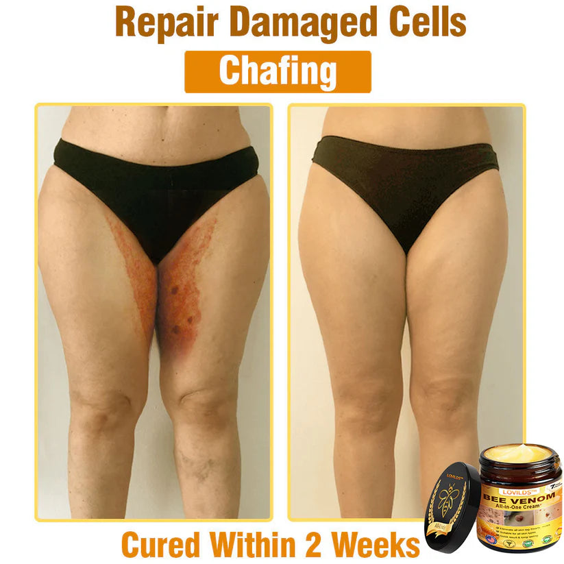 70% OFF🔥𝐋𝐎𝐕𝐈𝐋𝐃𝐒™ 𝐁𝐞𝐞 𝐕𝐞𝐧𝐨𝐦 𝐀𝐥𝐥-𝐢𝐧-𝐎𝐧𝐞 𝐂𝐫𝐞𝐚𝐦–🌸 Anti-aging,Hydrating, Skin Repair, Even Tone, Acne and Dark Spot Treatment, Wart and Mole Removal, Psoriasis Relief