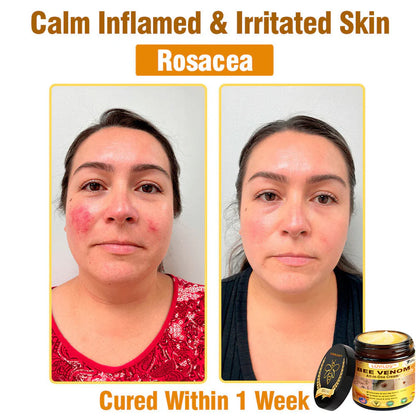 70% OFF🔥𝐋𝐎𝐕𝐈𝐋𝐃𝐒™ 𝐁𝐞𝐞 𝐕𝐞𝐧𝐨𝐦 𝐀𝐥𝐥-𝐢𝐧-𝐎𝐧𝐞 𝐂𝐫𝐞𝐚𝐦–🌸 Anti-aging,Hydrating, Skin Repair, Even Tone, Acne and Dark Spot Treatment, Wart and Mole Removal, Psoriasis Relief