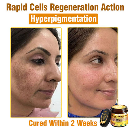 70% OFF🔥𝐋𝐎𝐕𝐈𝐋𝐃𝐒™ 𝐁𝐞𝐞 𝐕𝐞𝐧𝐨𝐦 𝐀𝐥𝐥-𝐢𝐧-𝐎𝐧𝐞 𝐂𝐫𝐞𝐚𝐦–🌸 Anti-aging,Hydrating, Skin Repair, Even Tone, Acne and Dark Spot Treatment, Wart and Mole Removal, Psoriasis Relief