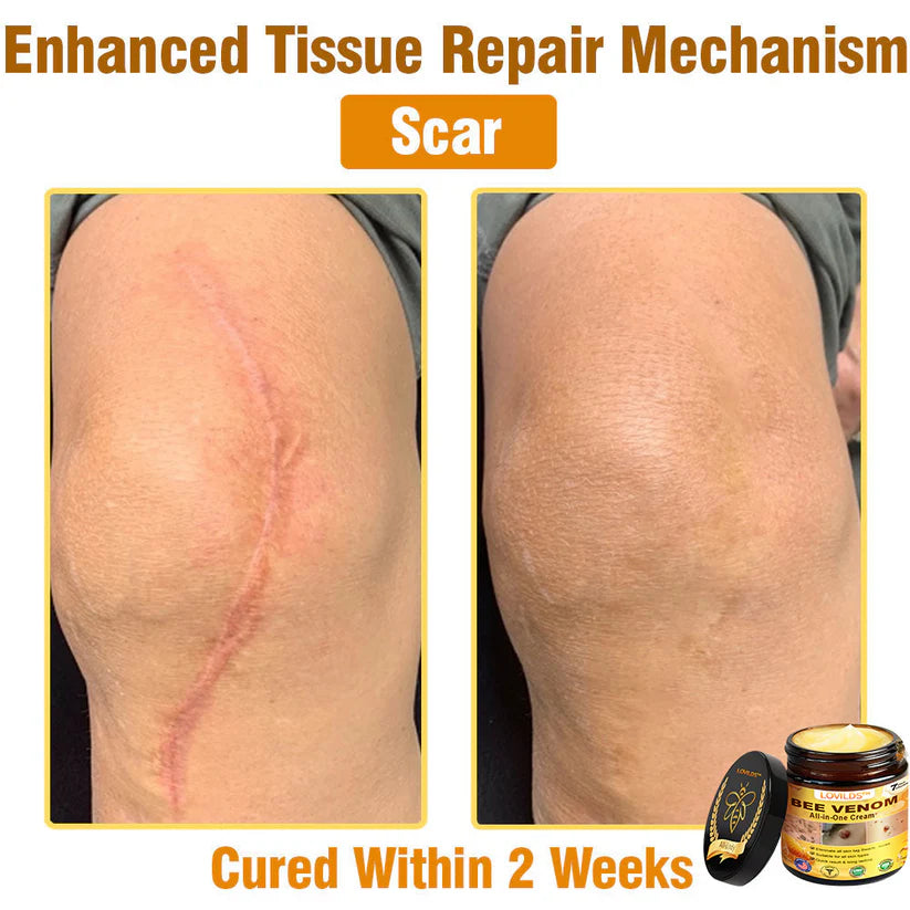 70% OFF🔥𝐋𝐎𝐕𝐈𝐋𝐃𝐒™ 𝐁𝐞𝐞 𝐕𝐞𝐧𝐨𝐦 𝐀𝐥𝐥-𝐢𝐧-𝐎𝐧𝐞 𝐂𝐫𝐞𝐚𝐦–🌸 Anti-aging,Hydrating, Skin Repair, Even Tone, Acne and Dark Spot Treatment, Wart and Mole Removal, Psoriasis Relief