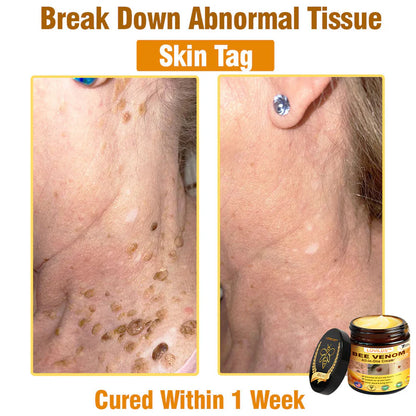 70% OFF🔥𝐋𝐎𝐕𝐈𝐋𝐃𝐒™ 𝐁𝐞𝐞 𝐕𝐞𝐧𝐨𝐦 𝐀𝐥𝐥-𝐢𝐧-𝐎𝐧𝐞 𝐂𝐫𝐞𝐚𝐦–🌸 Anti-aging,Hydrating, Skin Repair, Even Tone, Acne and Dark Spot Treatment, Wart and Mole Removal, Psoriasis Relief